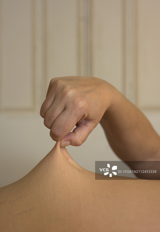 患埃勒斯-当洛斯综合征的女人手在拉伸腹部皮肤图片素材