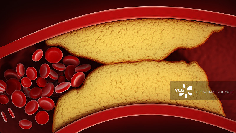3D增厚动脉和静脉可视化，冠心病图片素材
