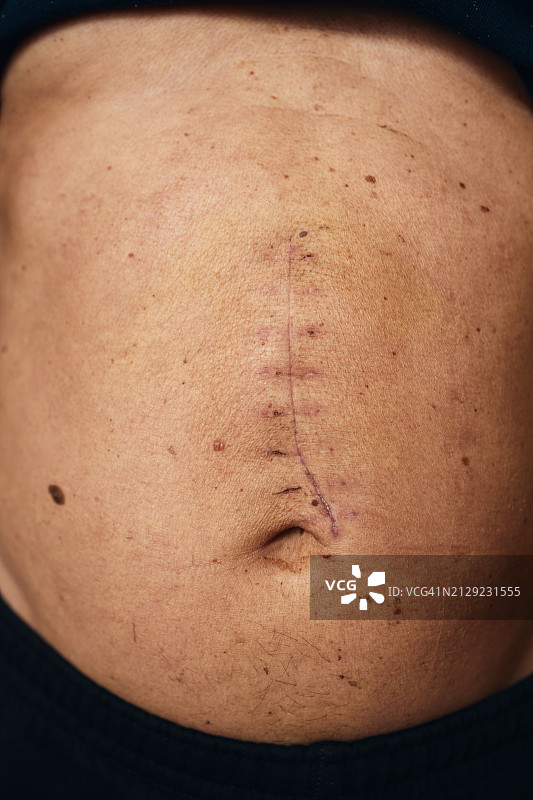 手术后的胃部疤痕图片素材
