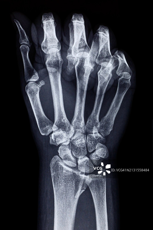 人体手部X光影像图片素材