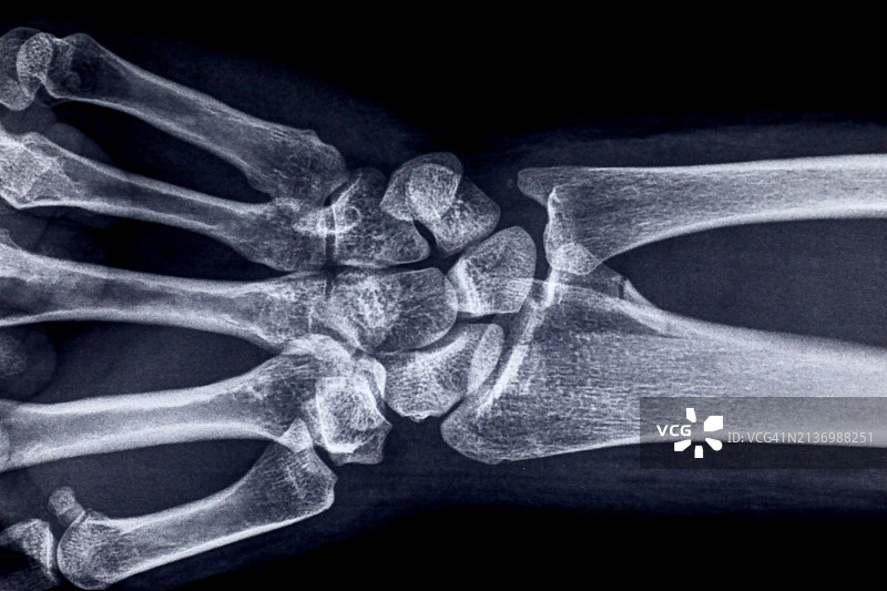 医疗保健的手腕X光片图片素材