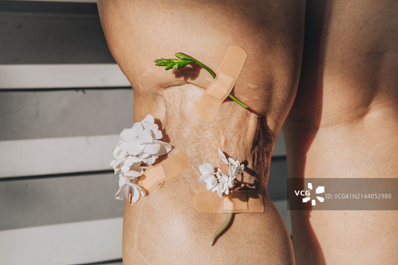 贴在女人腿部疤痕绷带上的花朵图片素材