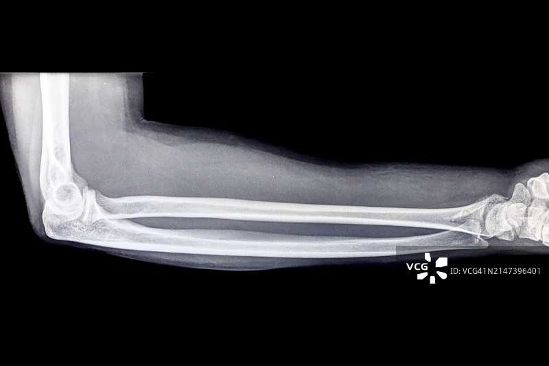 包含手腕和肘部的X光前臂图像图片素材