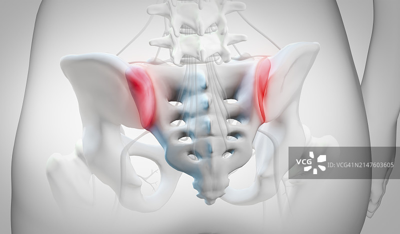 骶髂关节炎症示意图图片素材
