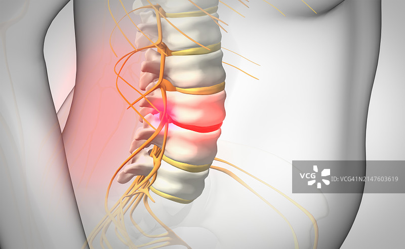 椎间盘突出插图图片素材