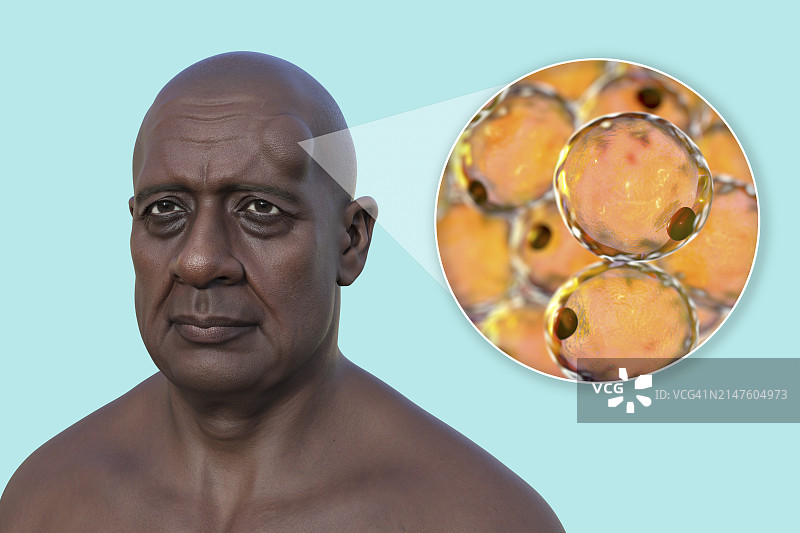 男人额头上的脂肪瘤插图图片素材
