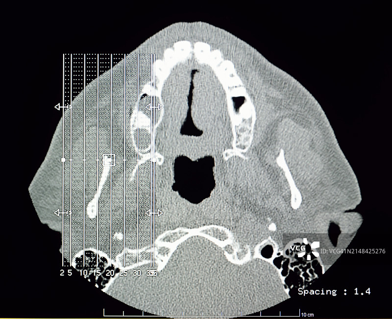 计算机断层扫描：颞下颌关节图片素材