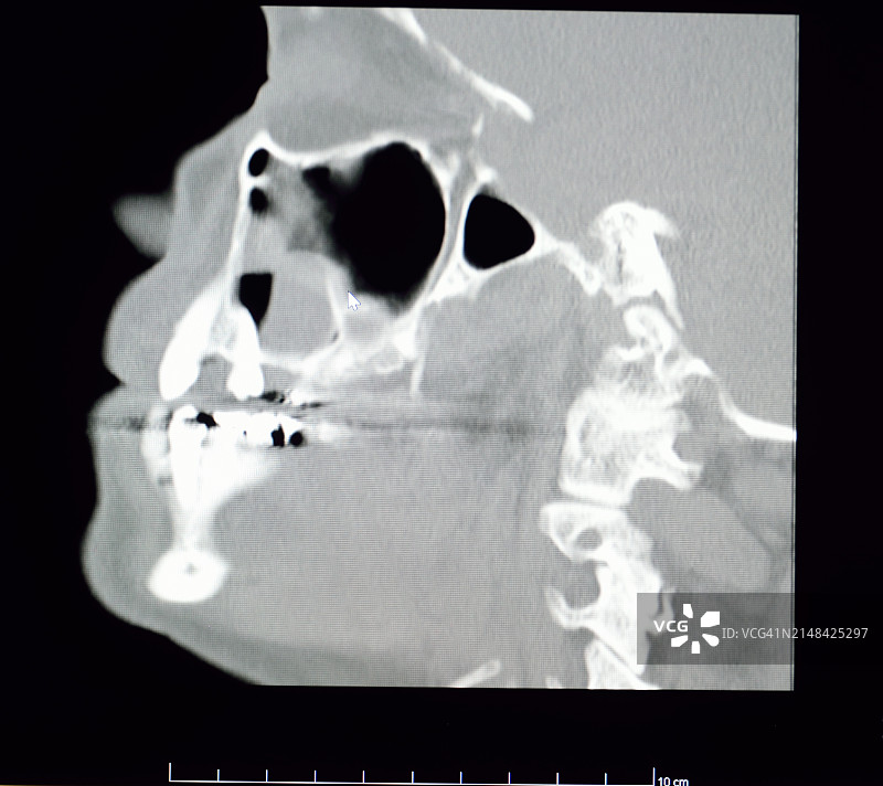 计算机断层扫描：颞下颌关节图片素材