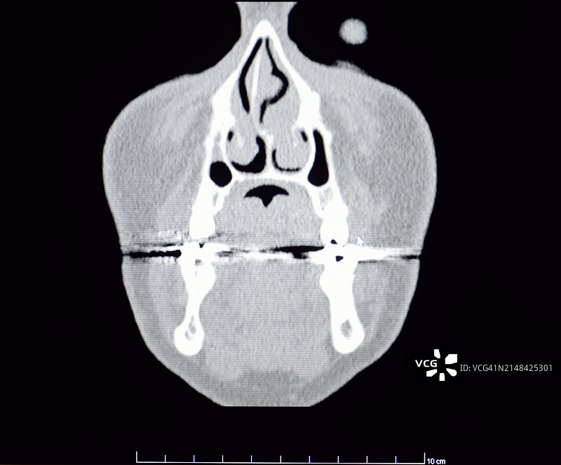 计算机断层扫描：颞下颌关节图片素材