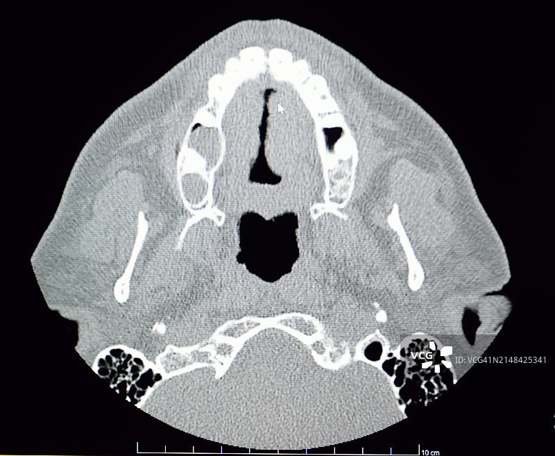 计算机断层扫描：颞下颌关节图片素材