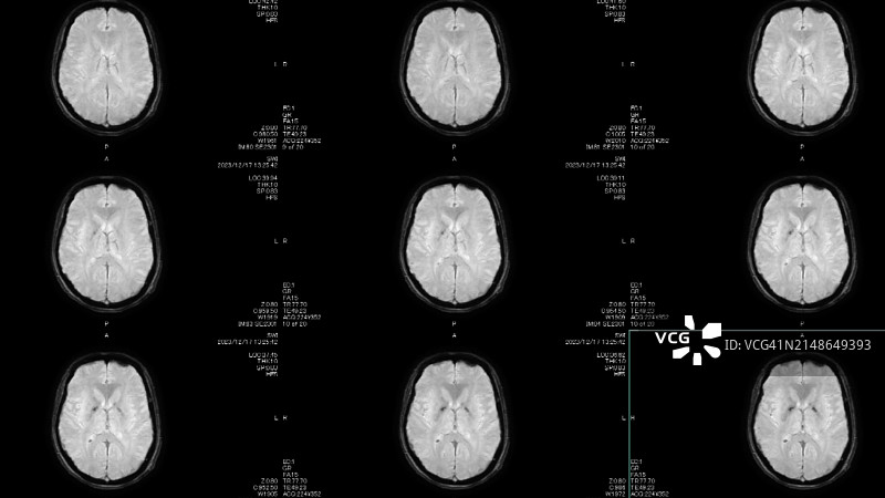 大脑磁共振扫描图片素材