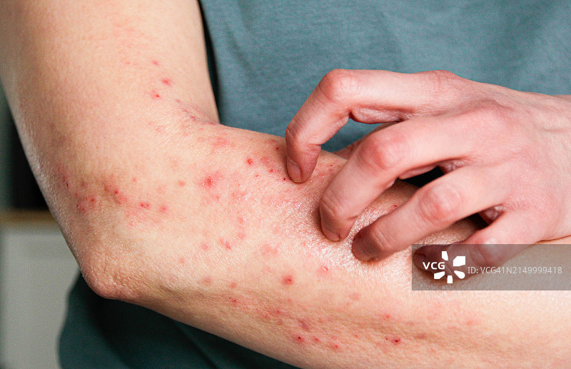 特应性湿疹图片素材