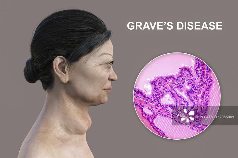 格雷夫斯病3D图图片素材