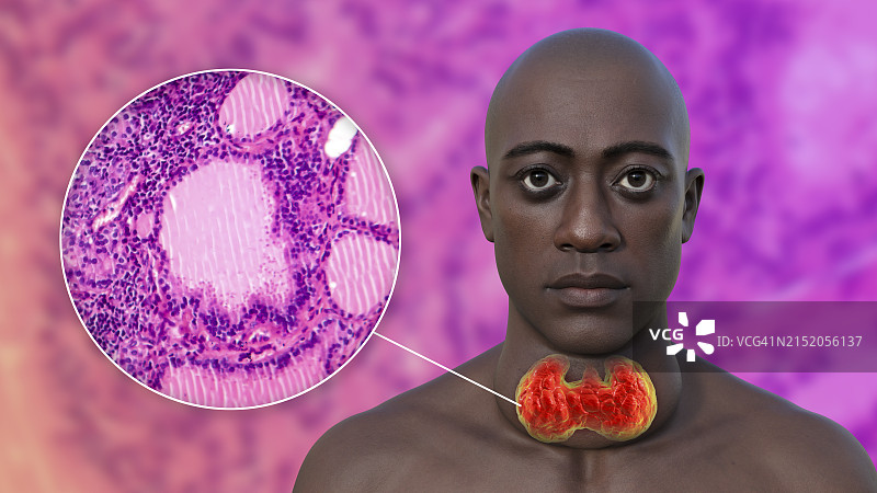 甲状腺肿大3D图示图片素材