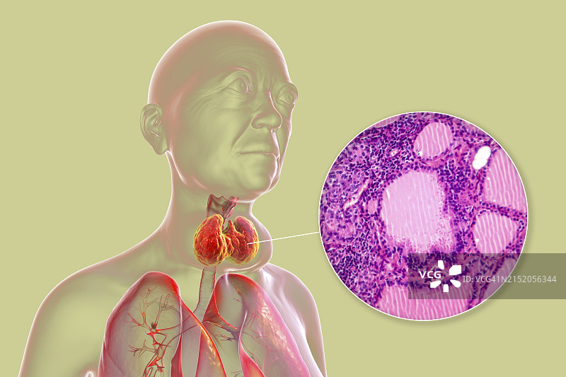 甲状腺毒性甲状腺肿3D图图片素材