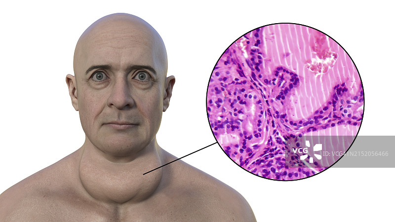 甲状腺肿大和眼球突出3D图图片素材