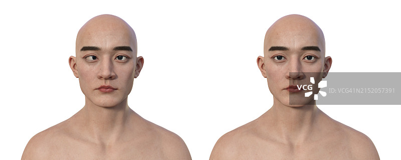 一名内斜视男子和一名健康的男子，插图图片素材