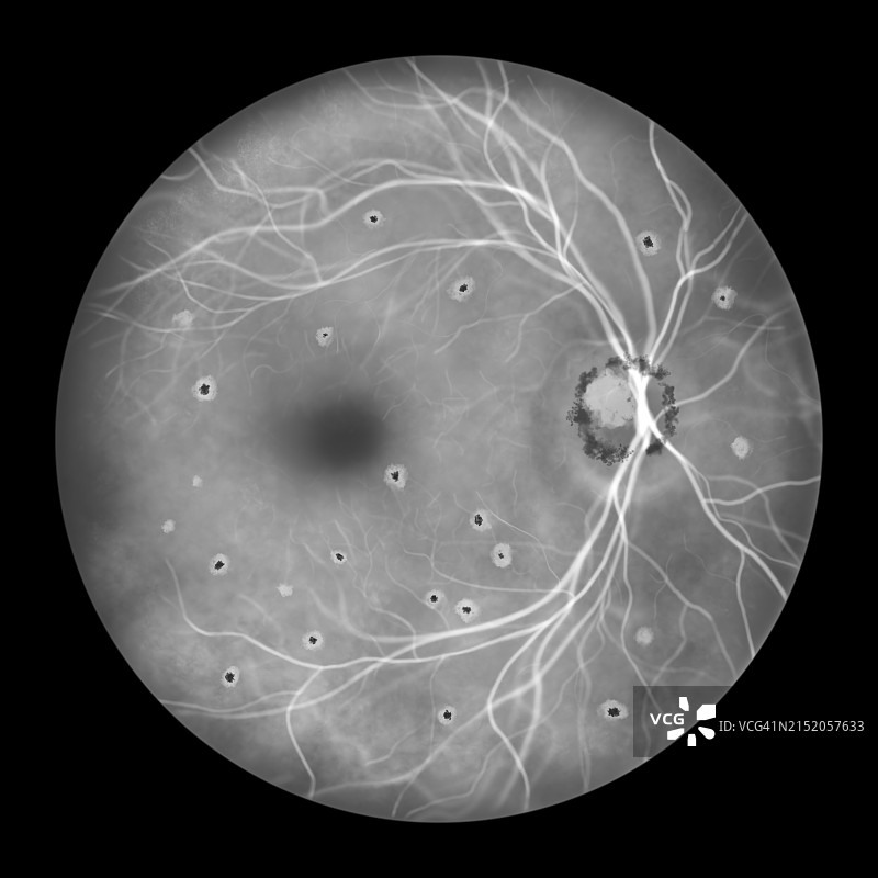 组织胞浆菌病引起的视网膜病变插图图片素材