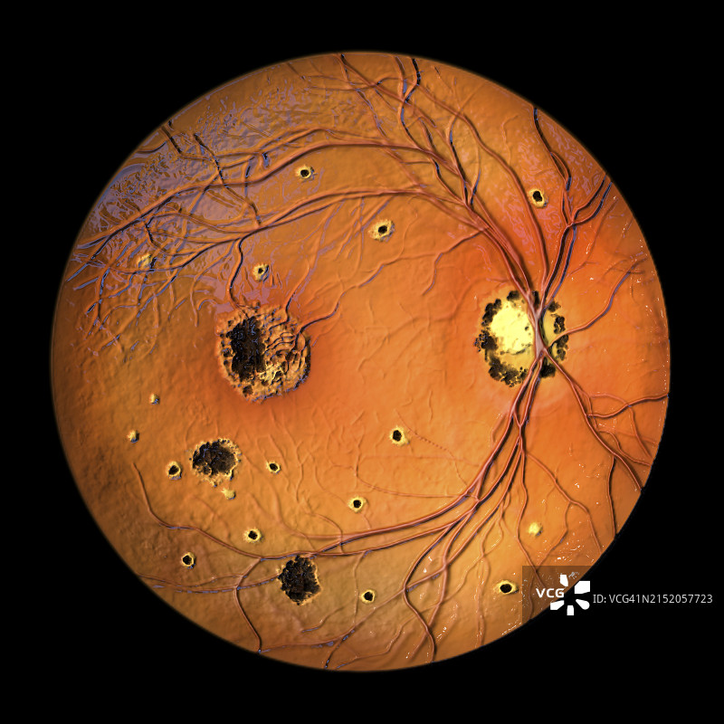 组织胞浆菌病引起的视网膜病变插图图片素材