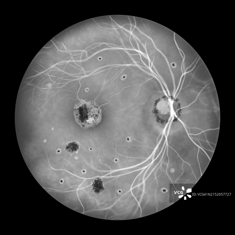 组织胞浆菌病引起的视网膜病变插图图片素材