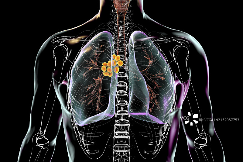 纵隔淋巴结肿大3D图图片素材