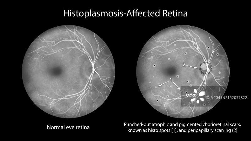 组织胞浆菌病引起的视网膜病变插图图片素材