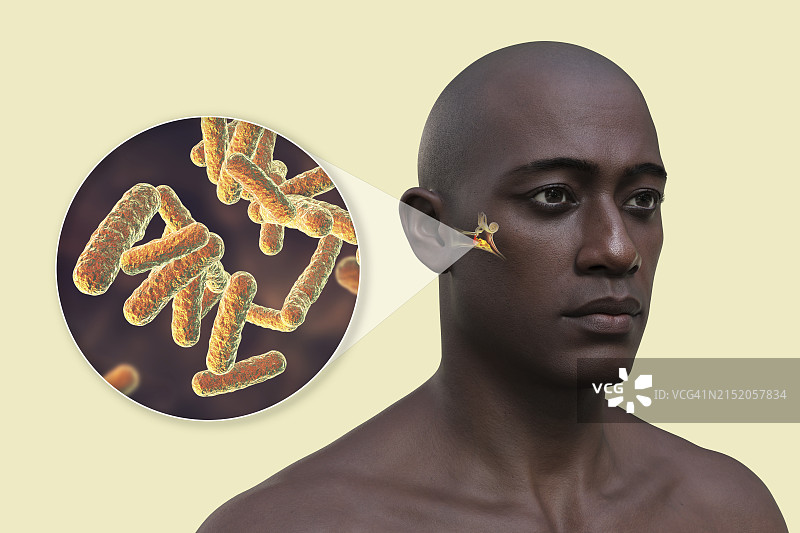 中耳感染，3D图图片素材