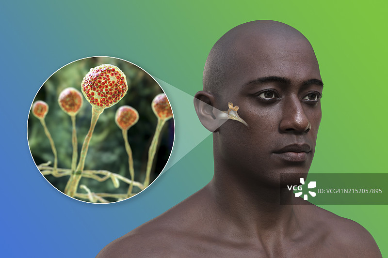 中耳感染，3D图图片素材