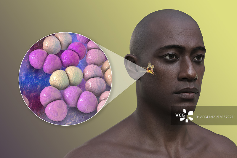 中耳感染，3D图图片素材