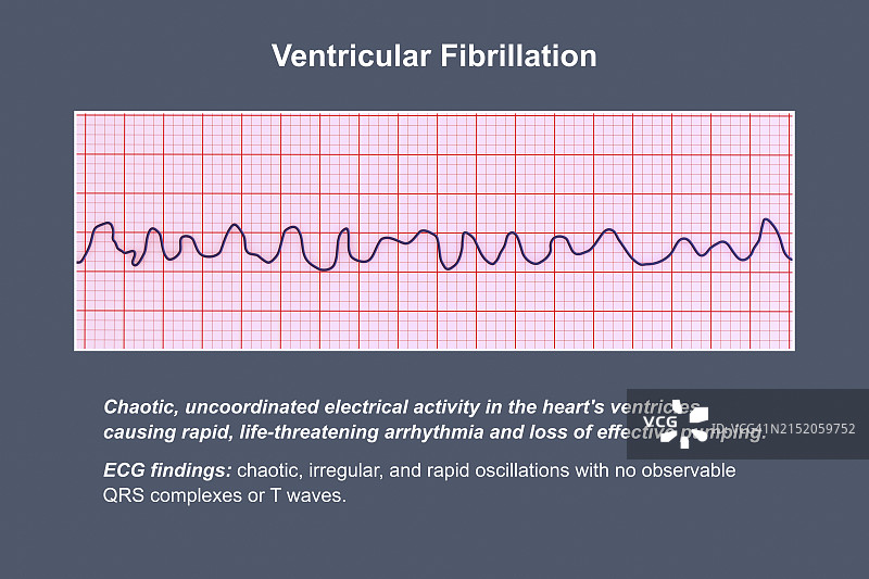 心室颤动心电图，图示图片素材