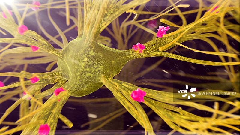 神经细胞上的淀粉样斑块，图示图片素材