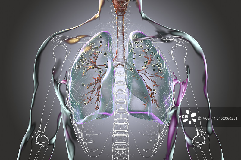 患有矽肺的人类肺部插图图片素材