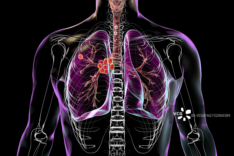 原发性肺结核插图图片素材