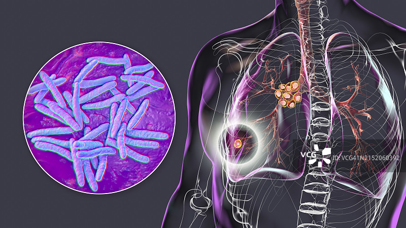 Ranke复合原发性肺结核图示图片素材