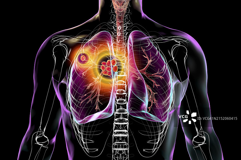 原发性肺结核插图图片素材