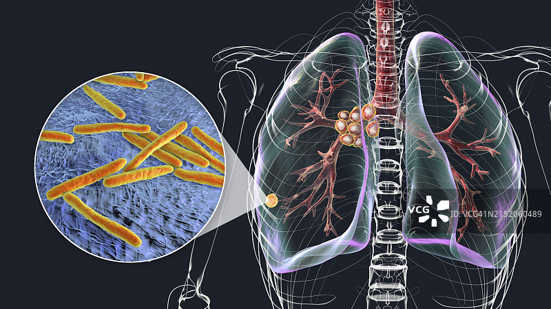 Ranke复合原发性肺结核图示图片素材