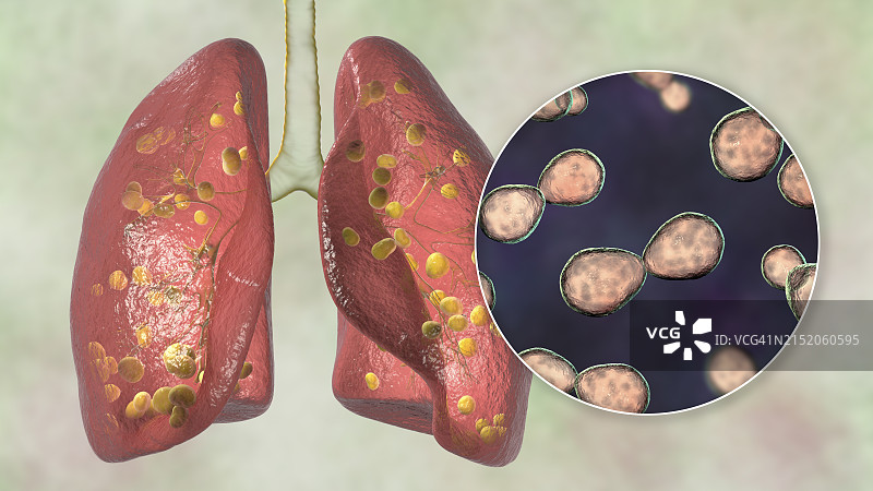 肺组织胞浆菌病插图图片素材