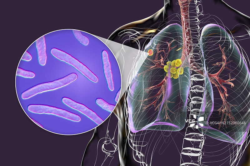 原发性肺结核插图图片素材