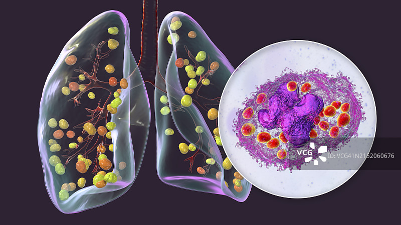 肺组织胞浆菌病插图图片素材