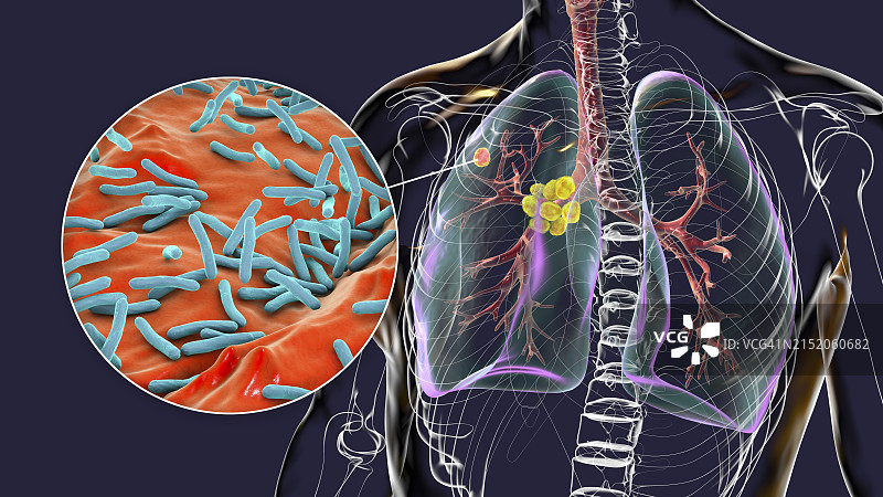 原发性肺结核插图图片素材