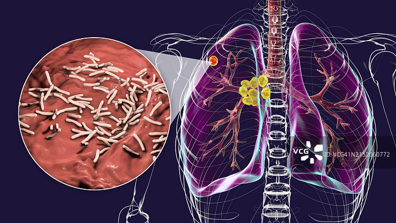 原发性肺结核插图图片素材