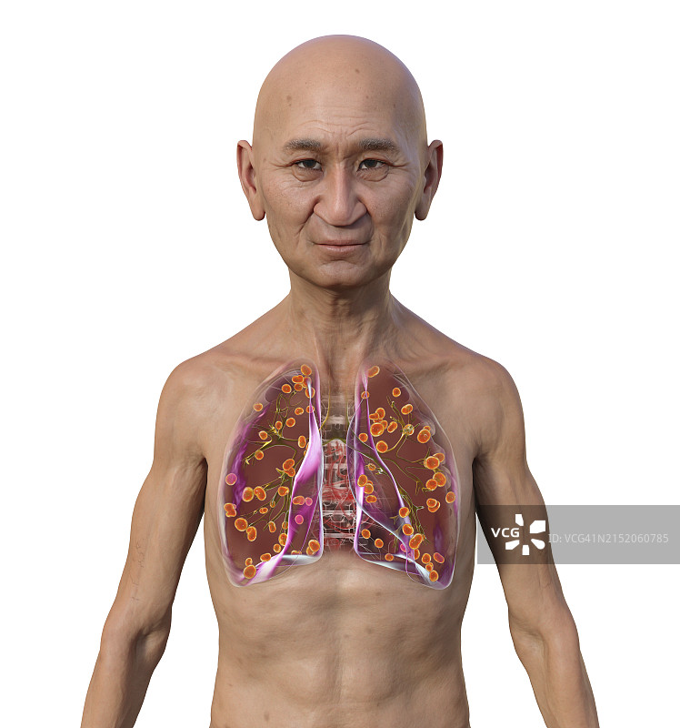 肺组织胞浆菌病插图图片素材