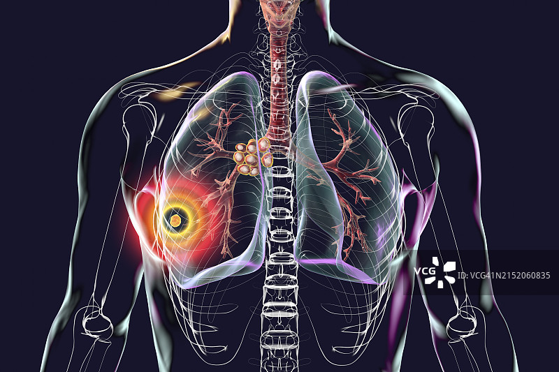 Ranke复合原发性肺结核图示图片素材