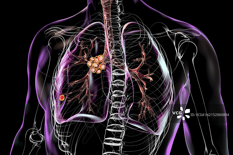 Ranke复合原发性肺结核图示图片素材