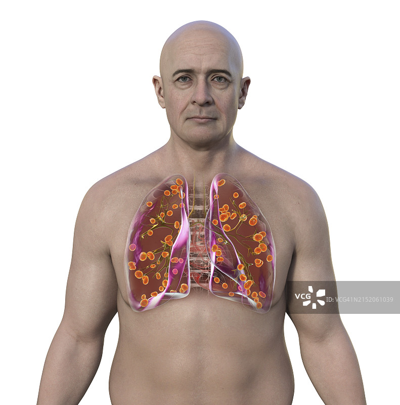 肺组织胞浆菌病插图图片素材