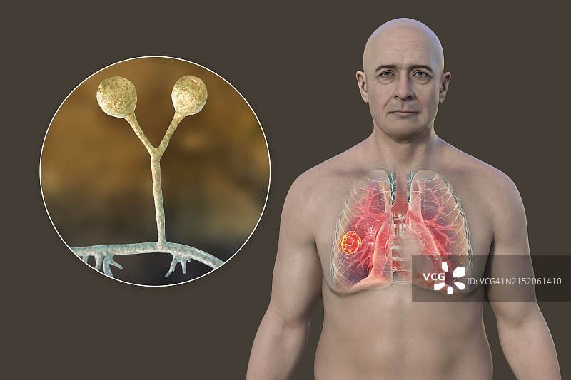 患有肺毛霉菌病病变的男人，插图图片素材