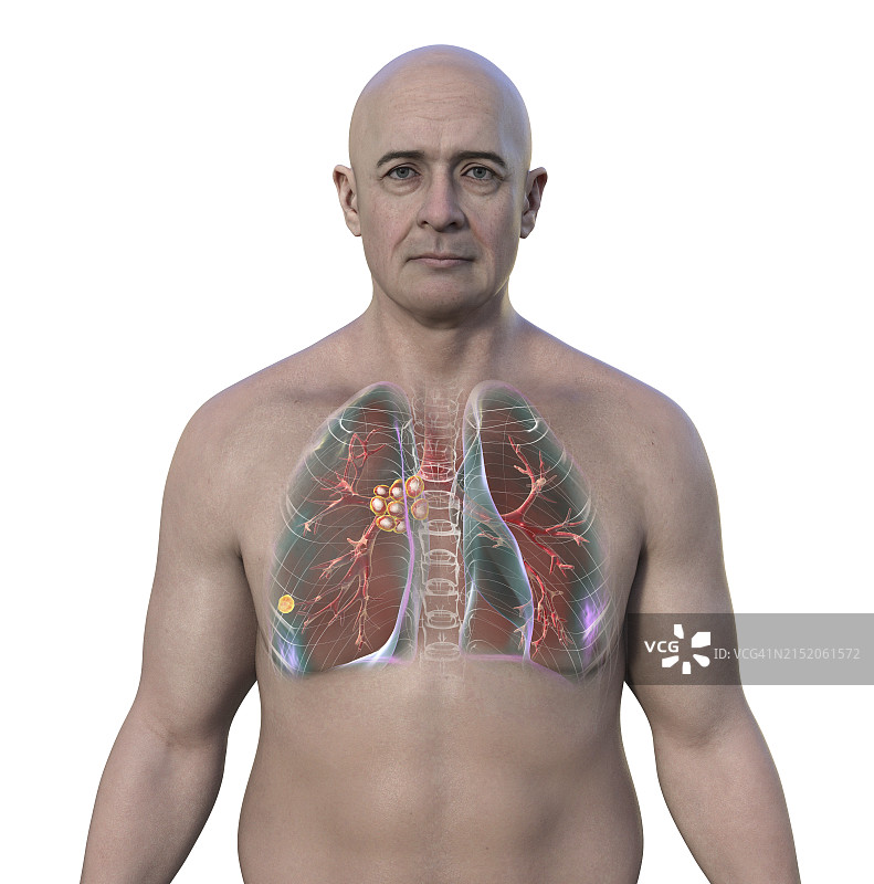 Ranke复合原发性肺结核图示图片素材