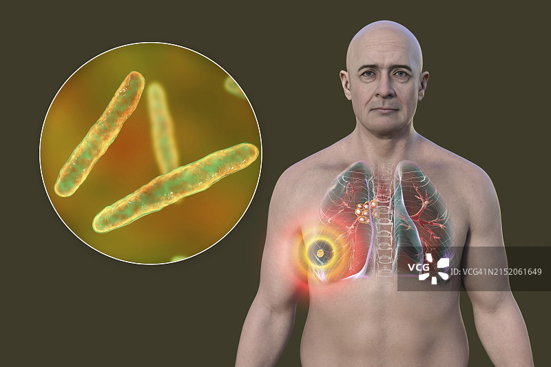 Ranke复合原发性肺结核图示图片素材