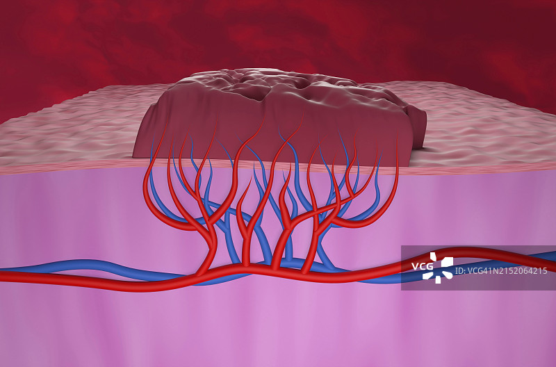 血管瘤插图图片素材