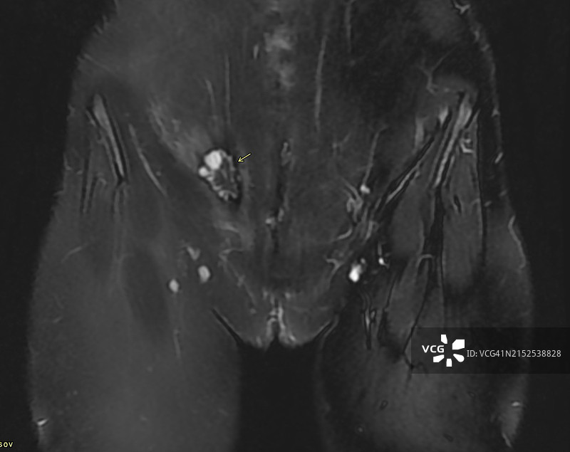 MR成像上腹壁子宫内膜异位症（AWE）的表现，冠状T2FatSat图像图片素材
